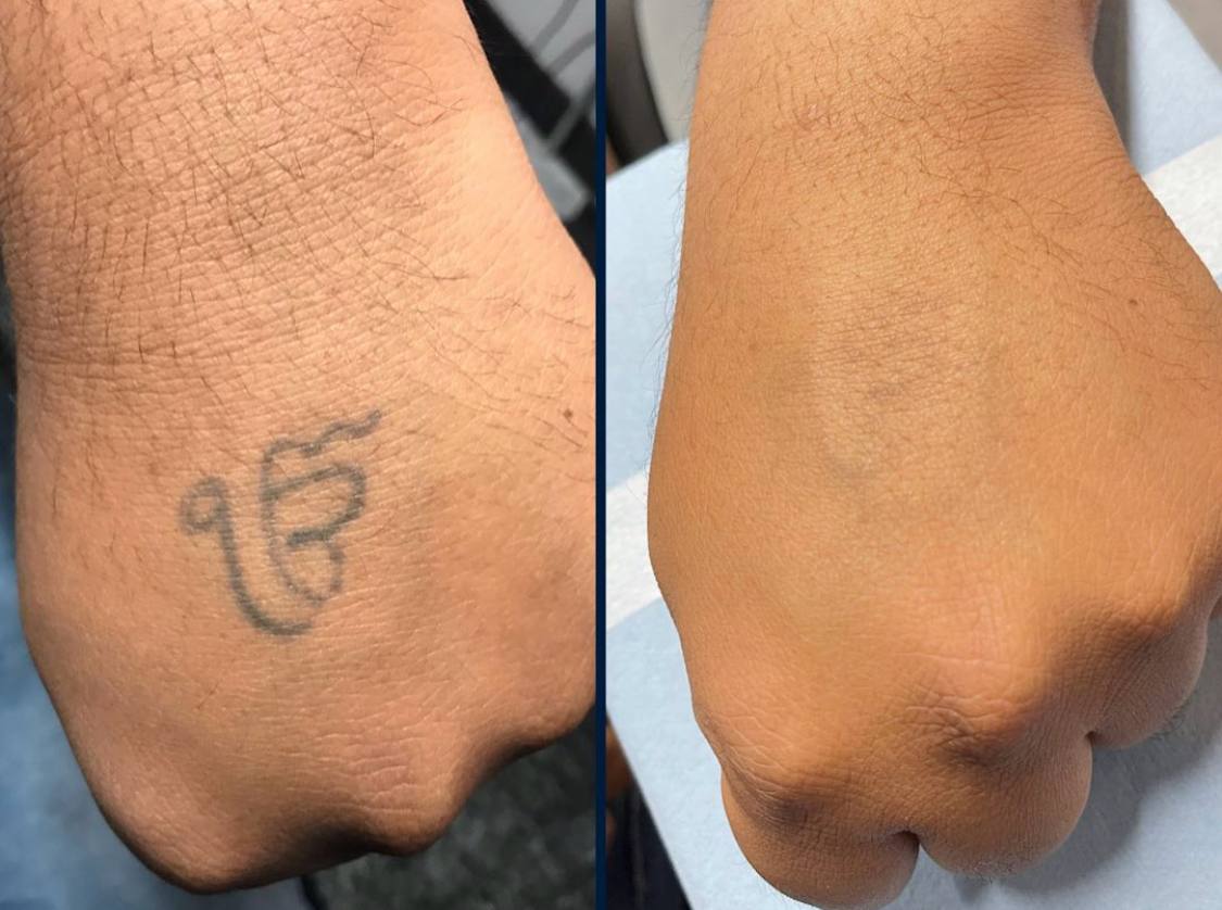 Resultat detatouage 3