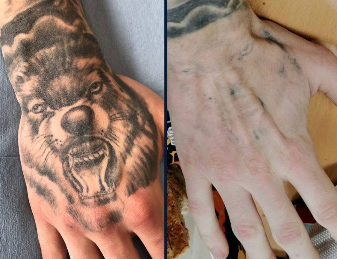 Resultat detatouage 5